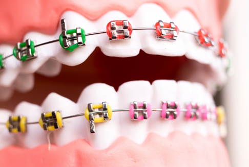 Metal Braces in Overland Park 