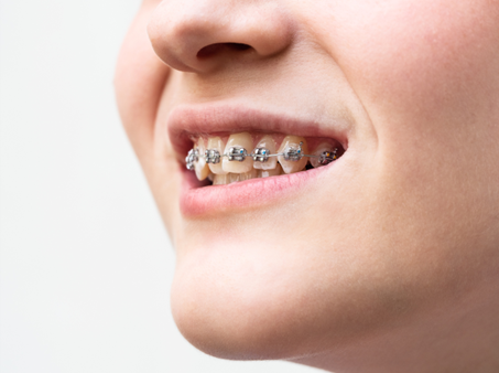 Family Orthodontics in Overland Park