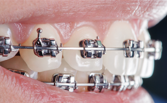 Metal Braces in Overland Park