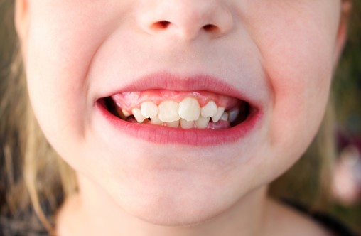 Crooked Teeth Orthodontist in Overland Park