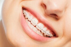 Clear Braces in Overland Park