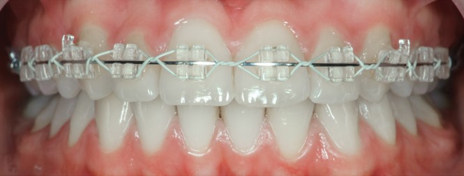 Clear Braces in Overland Park
