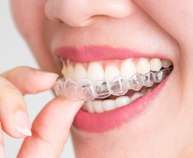 Invisalign in Prairie Village