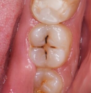 Cavity Treatment in Overland Park