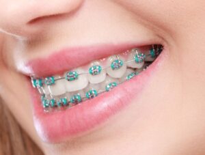 Clear Braces in Leawood