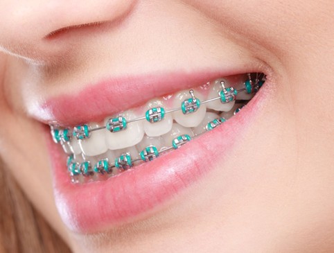 Clear Braces in Leawood