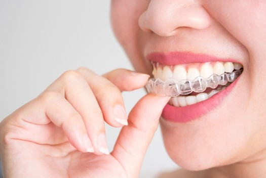 Clear Braces in Overland Park