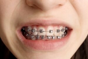 Metal Braces in Overland Park