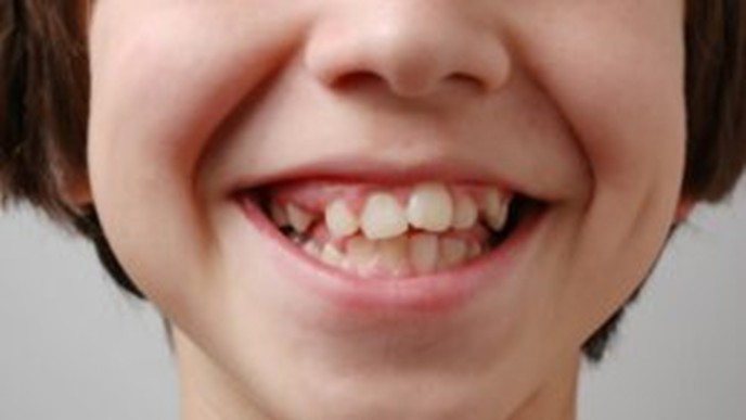 dental mouthguards in Overland Park