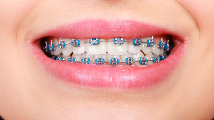 Metal Braces in Overland Park