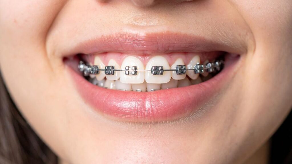 Metal Braces in Prairie Village