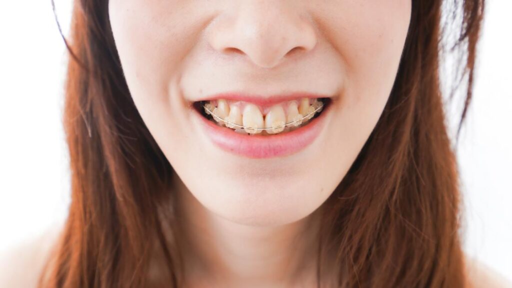 Clear Braces in Leawood