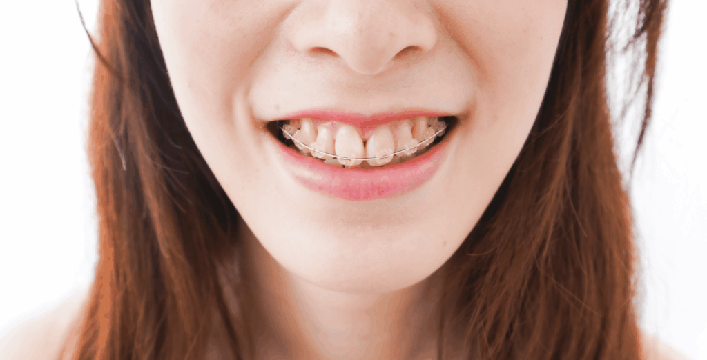 Clear Braces in Leawood