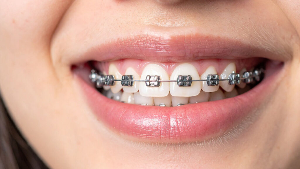Metal Braces in Leawood