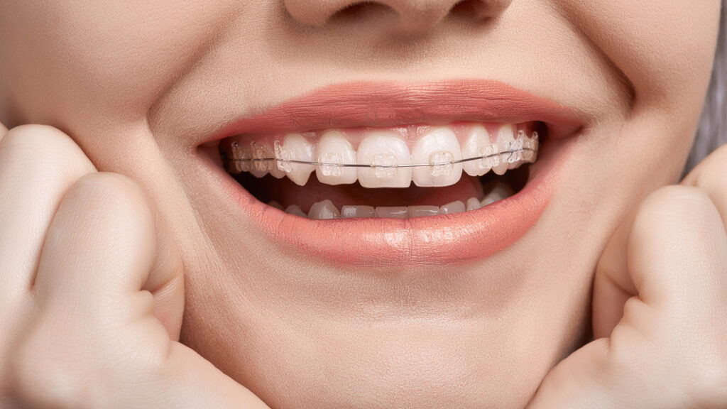 What Are the Benefits of Getting Braces Nowadays?