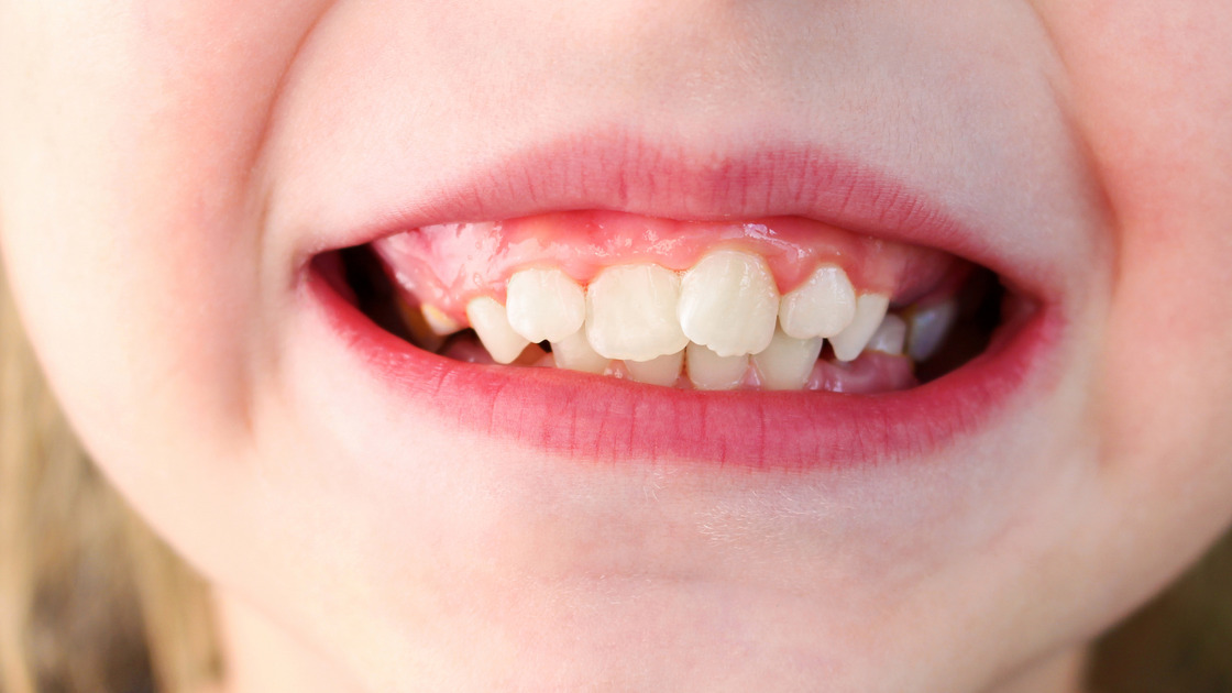 Metal Braces in LeawoodOverland Park