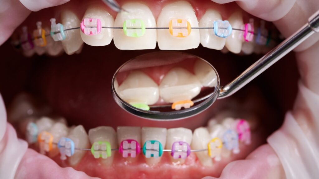 pediatric orthodontist in Overland Park