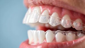 Clarity by 3M in Prairie Village