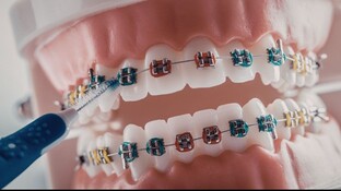 Clear Braces in Overland Park