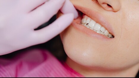 Cavity Treatment in Leawood