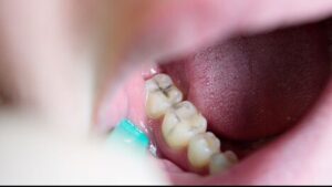 Cavity Treatment in Leawood