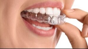 Clear Aligners in Prairie Village