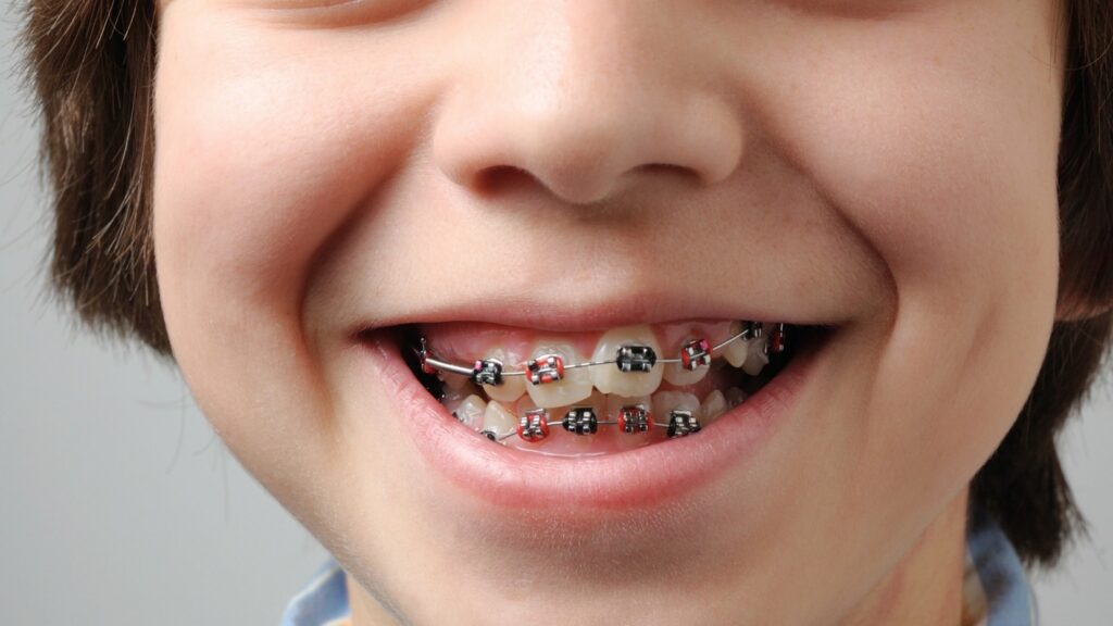 crooked teeth orthodontist in Overland Park