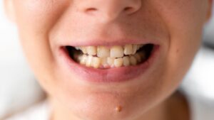 crooked teeth orthodontist in Overland Park