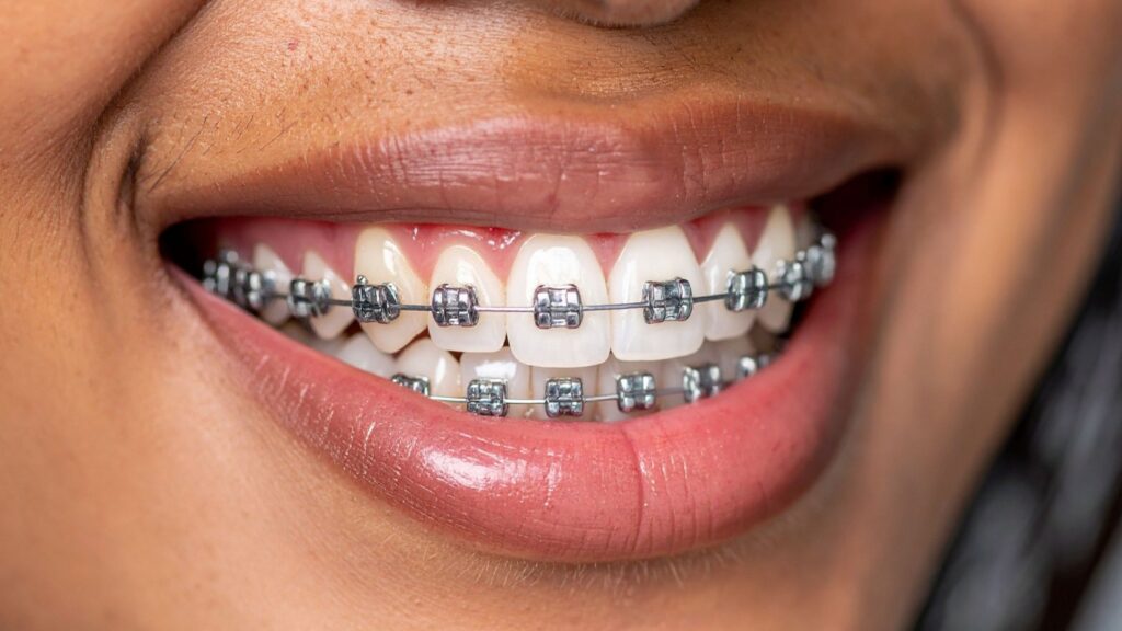 metal braces in Bonner Springs