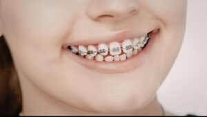 Clear Braces in Prairie Village