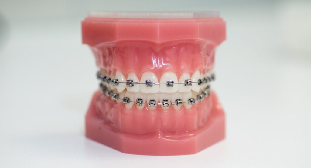 Clear Braces in Prairie Village