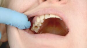 Cavity Treatment in Leawood