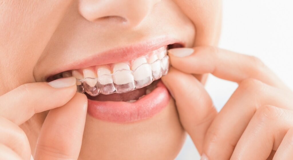 Invisalign in Leawood