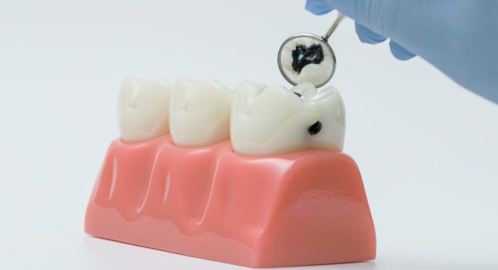 Cavity Treatment in Bonner Springs