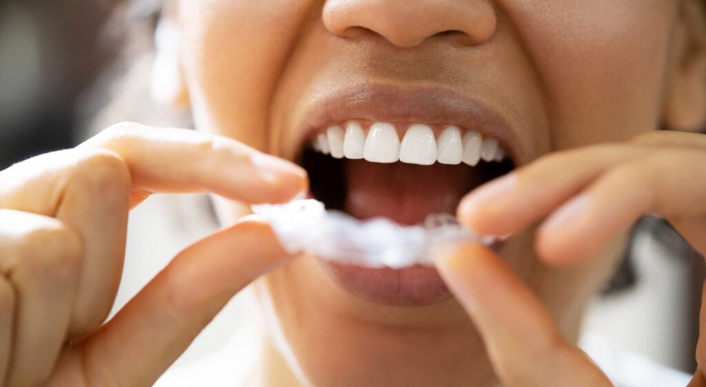 Dental Night Guards in Bonner Springs