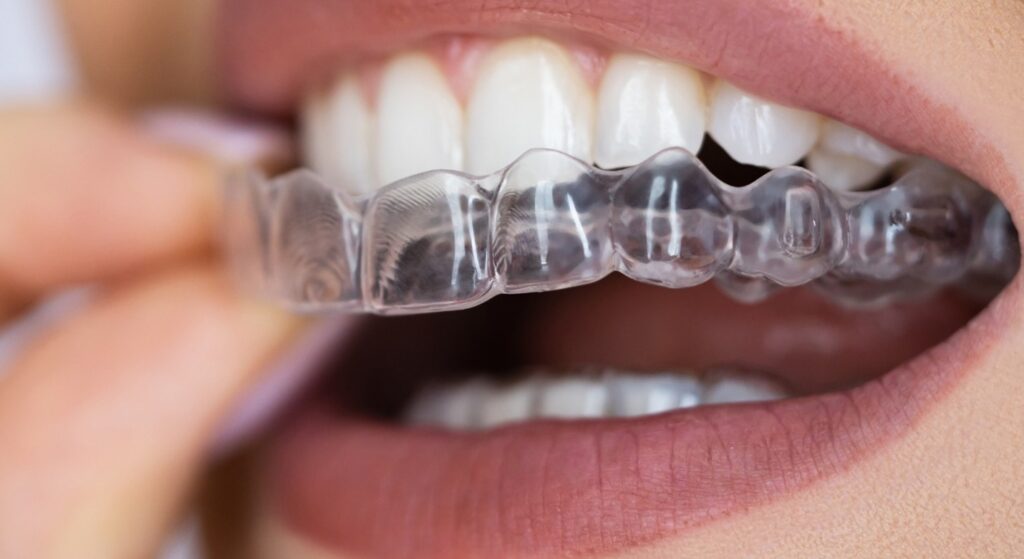 Invisalign in Prairie Village