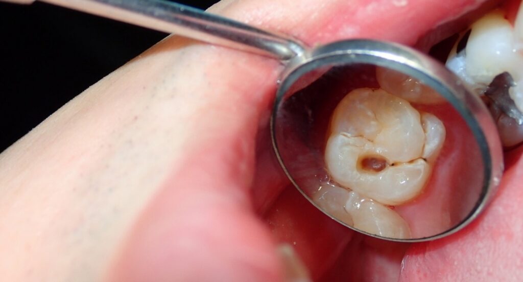Cavity Treatment in Overland Park