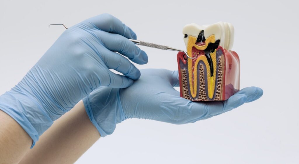 Cavity Treatment in Overland Park